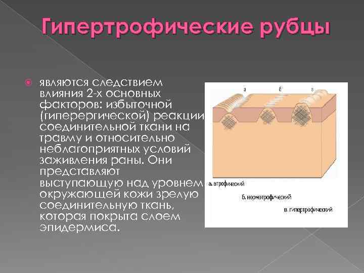 Гипертрофические рубцы являются следствием влияния 2 -х основных факторов: избыточной (гиперергической) реакции соединительной ткани