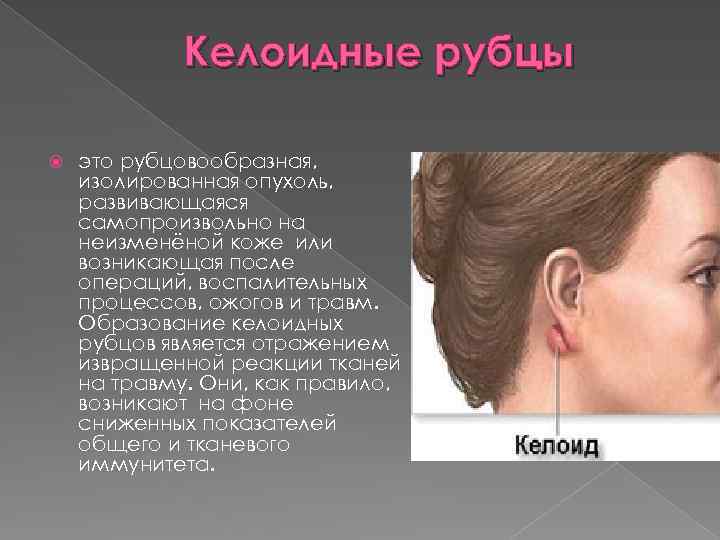 Келоидные рубцы это рубцовообразная, изолированная опухоль, развивающаяся самопроизвольно на неизменёной коже или возникающая после