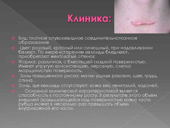 Клиника: Вид: плотное опухолевидное соединительнотканное образование Цвет: розовый, красный или синюшный, при надавливании белеют.