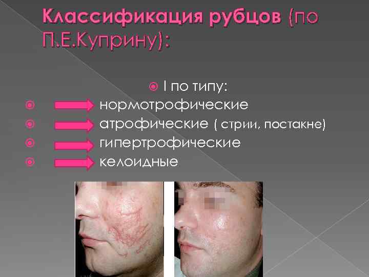 Классификация рубцов (по П. Е. Куприну): I по типу: нормотрофические атрофические ( стрии, постакне)