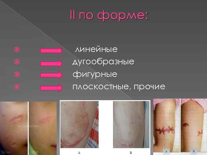 II по форме: линейные дугообразные фигурные плоскостные, прочие 