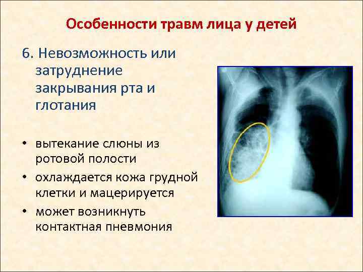 Особенности травм лица у детей 6. Невозможность или затруднение закрывания рта и глотания •