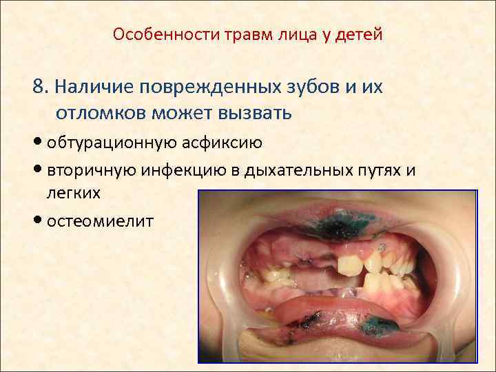 Особенности травм лица у детей 8. Наличие поврежденных зубов и их отломков может вызвать