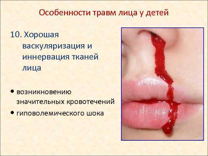 Особенности травм лица у детей 10. Хорошая васкуляризация и иннервация тканей лица возникновению значительных