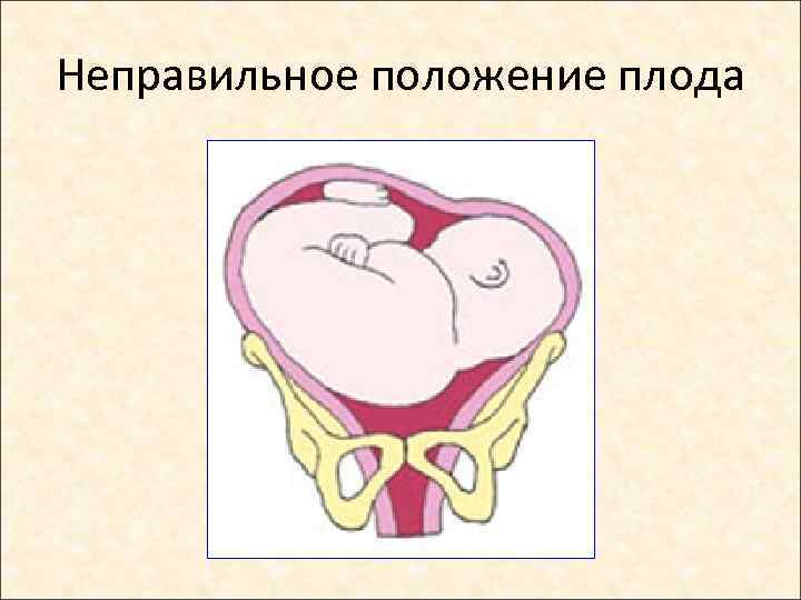 Неправильное положение плода 