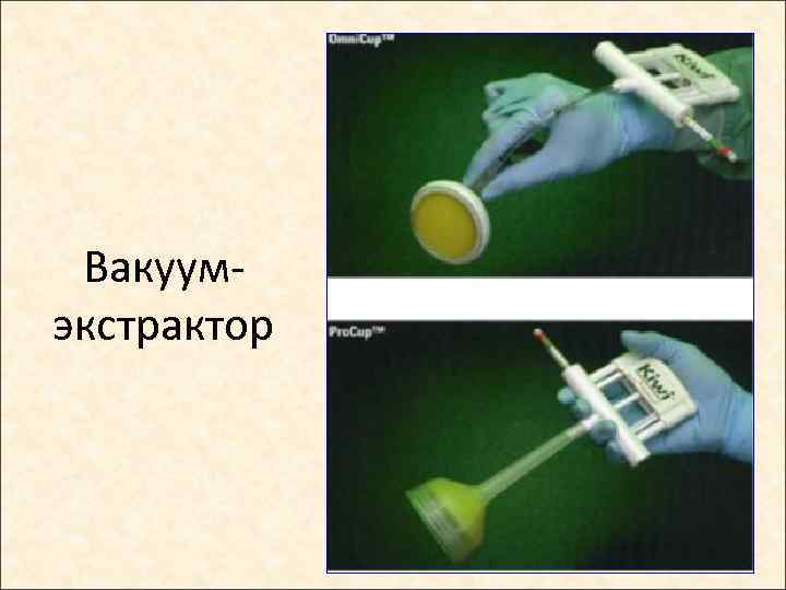 Вакуумэкстрактор 