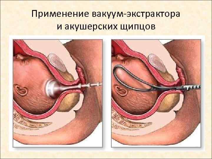 Применение вакуум-экстрактора и акушерских щипцов 