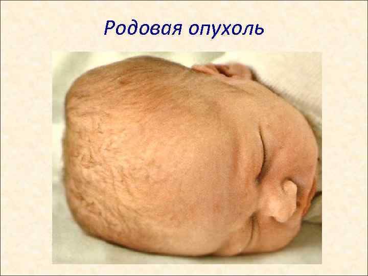 Родовая опухоль 
