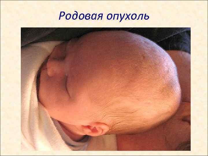 Родовая опухоль 
