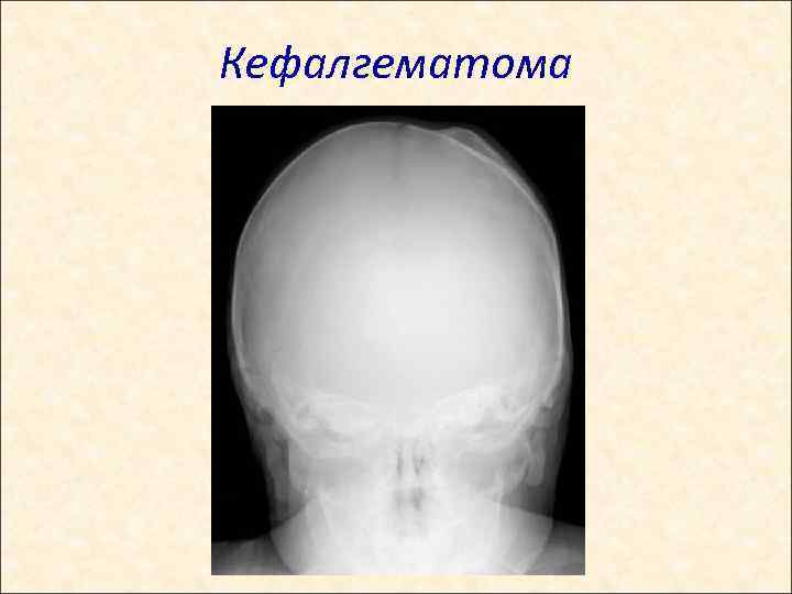Кефалгематома 