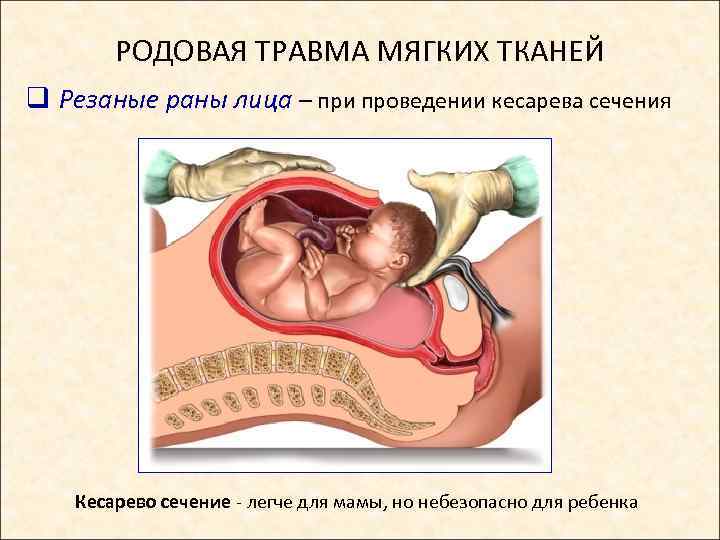 РОДОВАЯ ТРАВМА МЯГКИХ ТКАНЕЙ q Резаные раны лица – при проведении кесарева сечения Кесарево