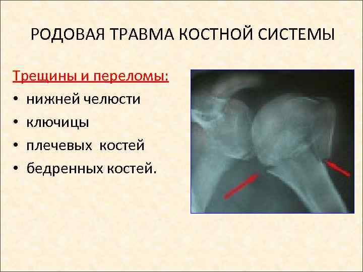 РОДОВАЯ ТРАВМА КОСТНОЙ СИСТЕМЫ Трещины и переломы: • нижней челюсти • ключицы • плечевых