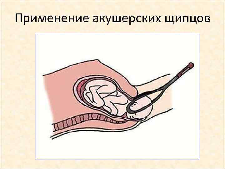 Применение акушерских щипцов 