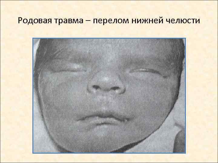 Родовая травма – перелом нижней челюсти 