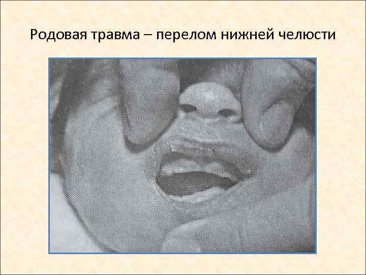 Родовая травма – перелом нижней челюсти 