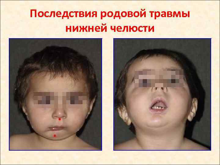 Последствия родовой травмы нижней челюсти 