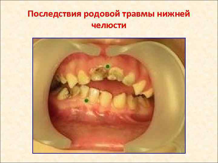 Последствия родовой травмы нижней челюсти 