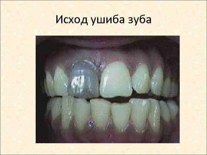 Исход ушиба зуба 