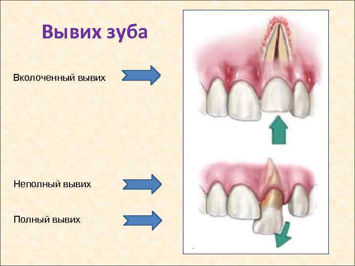 Вывих зуба Вколоченный вывих Неполный вывих Полный вывих 