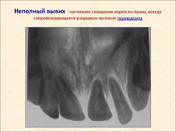 Неполный вывих - частичное смещение корня из лунки, всегда сопровождающееся разрывом волокон периодонта 