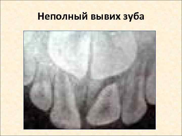 Неполный вывих зуба 