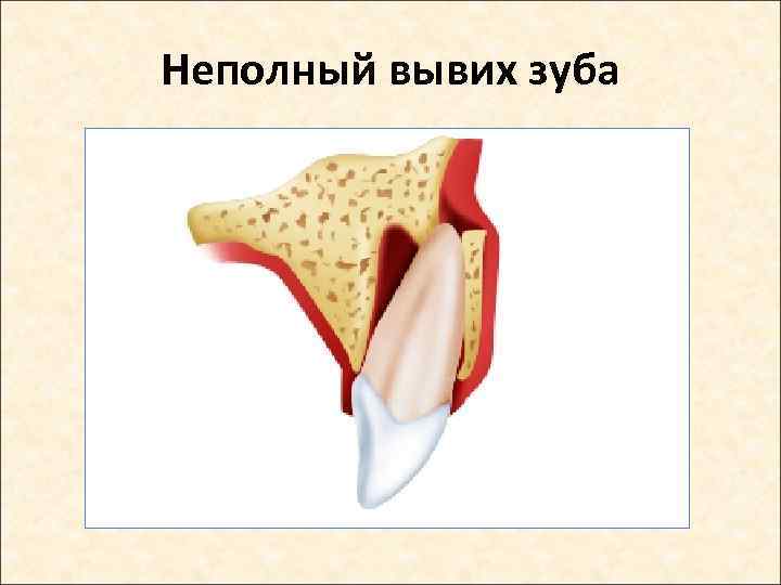 Неполный вывих зуба 