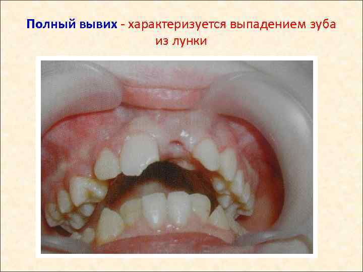 Полный вывих - характеризуется выпадением зуба из лунки 