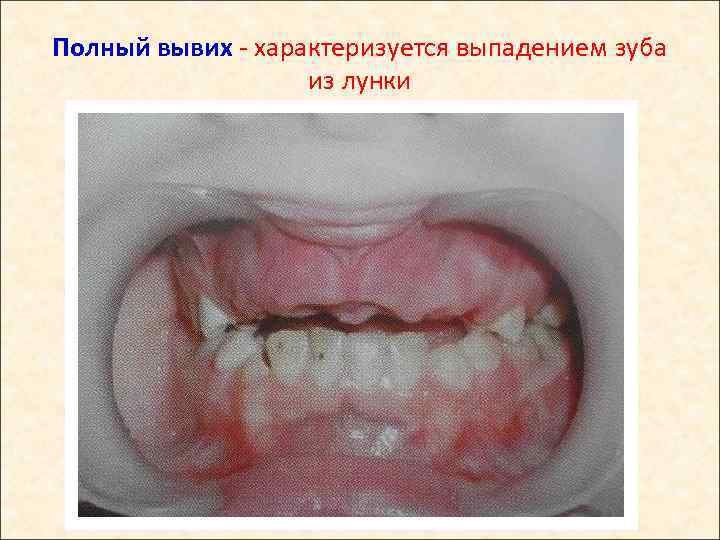 Полный вывих - характеризуется выпадением зуба из лунки 
