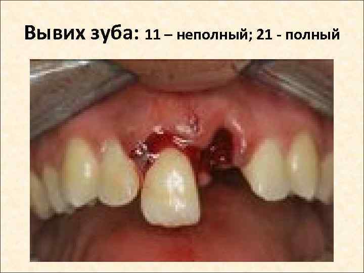Вывих зуба: 11 – неполный; 21 - полный 