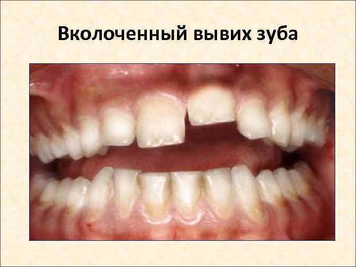 Вколоченный вывих зуба 