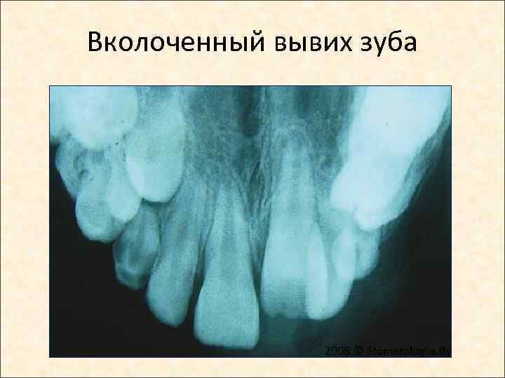 Вколоченный вывих зуба 