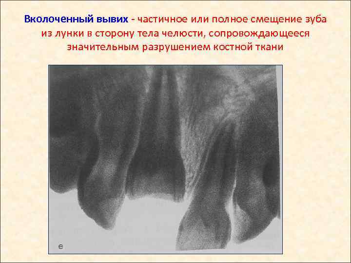 Вколоченный вывих - частичное или полное смещение зуба из лунки в сторону тела челюсти,