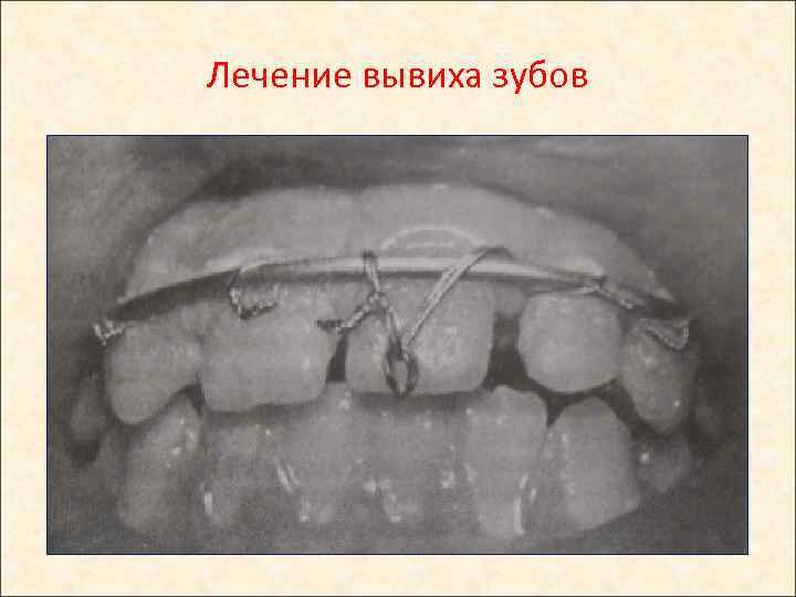 Лечение вывиха зубов 