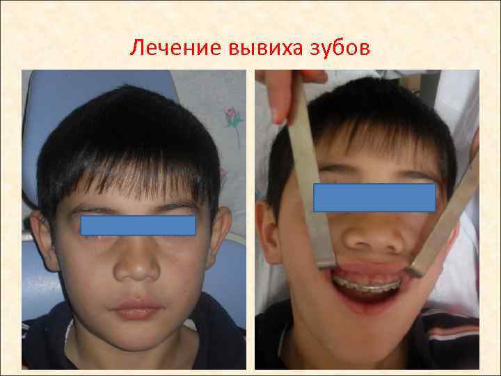 Лечение вывиха зубов 