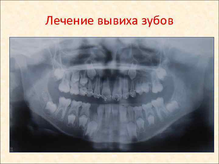 Лечение вывиха зубов 