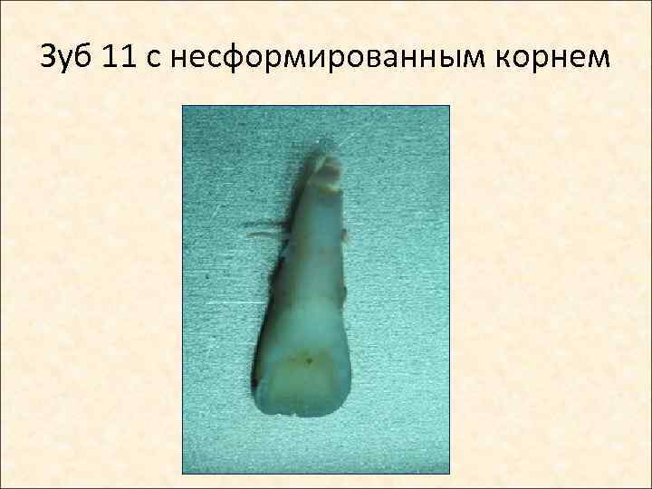 Зуб 11 с несформированным корнем 