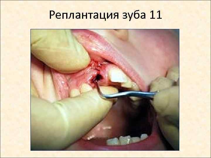 Реплантация зуба 11 