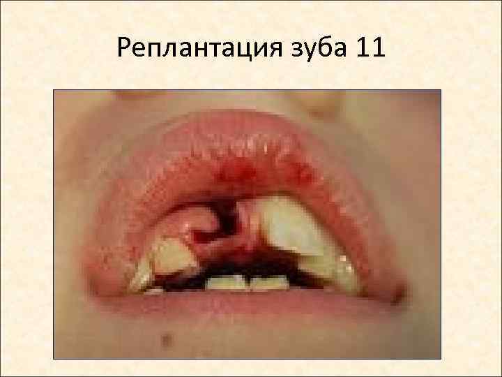 Реплантация зуба 11 