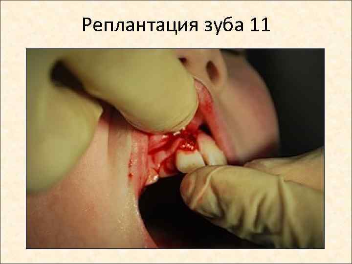 Реплантация зуба 11 