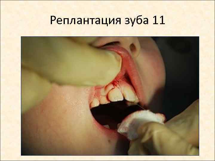 Реплантация зуба 11 
