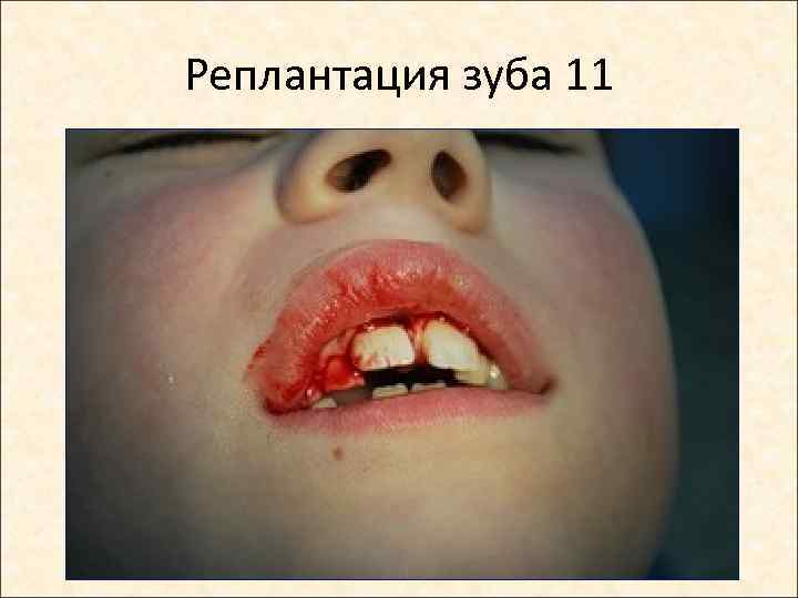 Реплантация зуба 11 