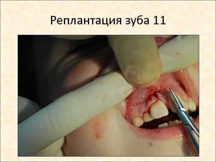 Реплантация зуба 11 