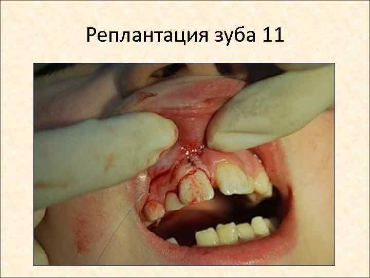 Реплантация зуба 11 