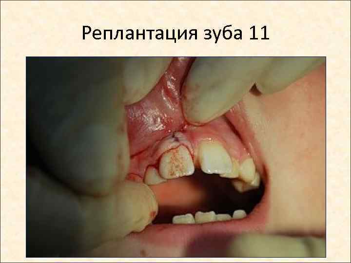 Реплантация зуба 11 