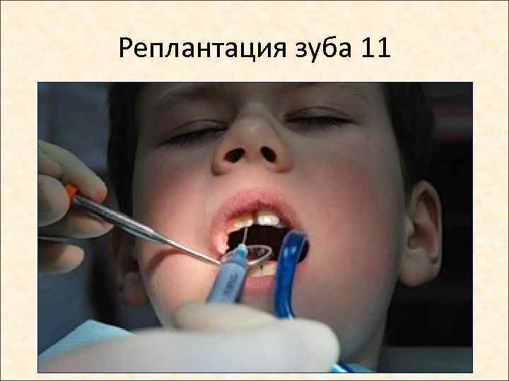 Реплантация зуба 11 