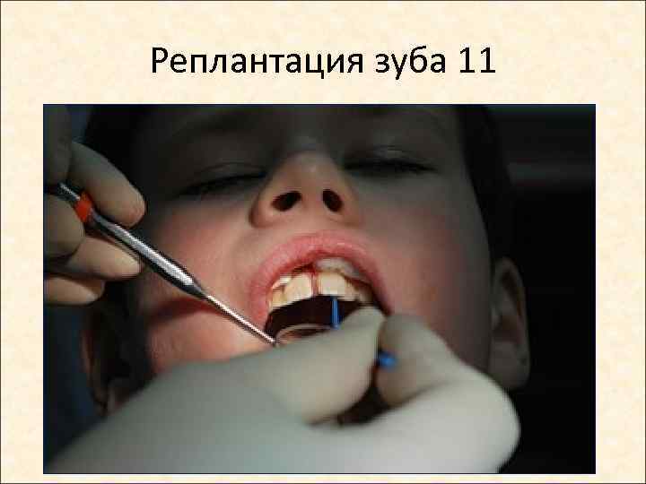 Реплантация зуба 11 