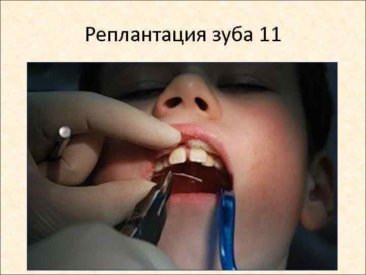 Реплантация зуба 11 