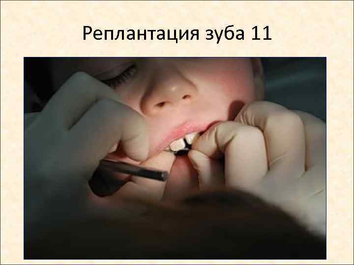 Реплантация зуба 11 