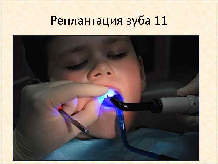 Реплантация зуба 11 