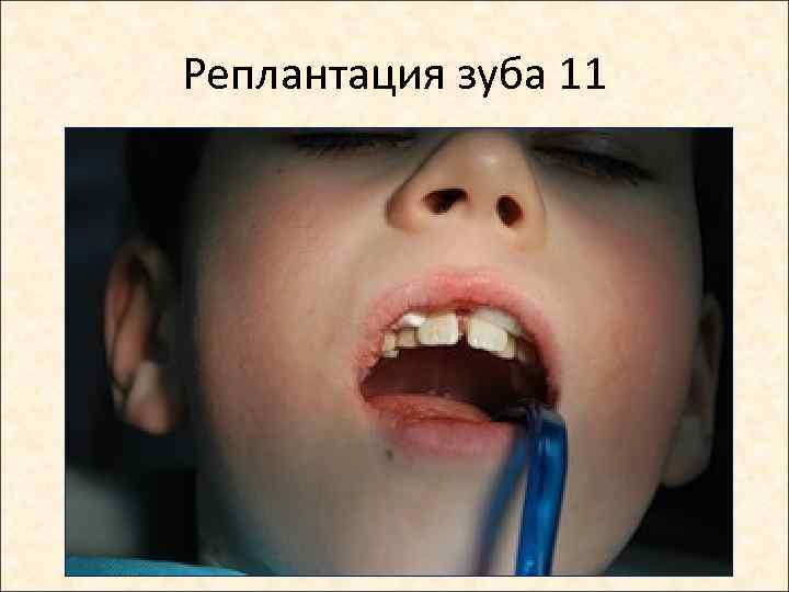 Реплантация зуба 11 